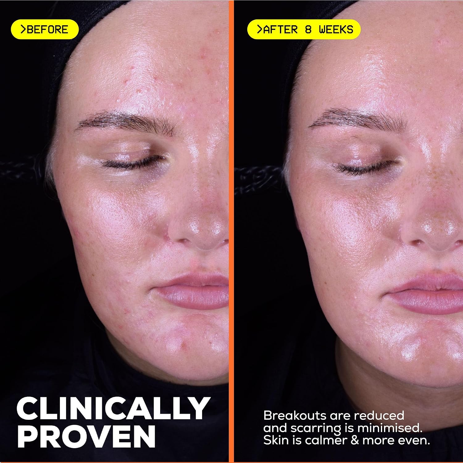 Glow Hub The Scar Slayer Facial Serum with Vitamin C for Anti-Pigmentation and Blemish Prone Skin 30ml